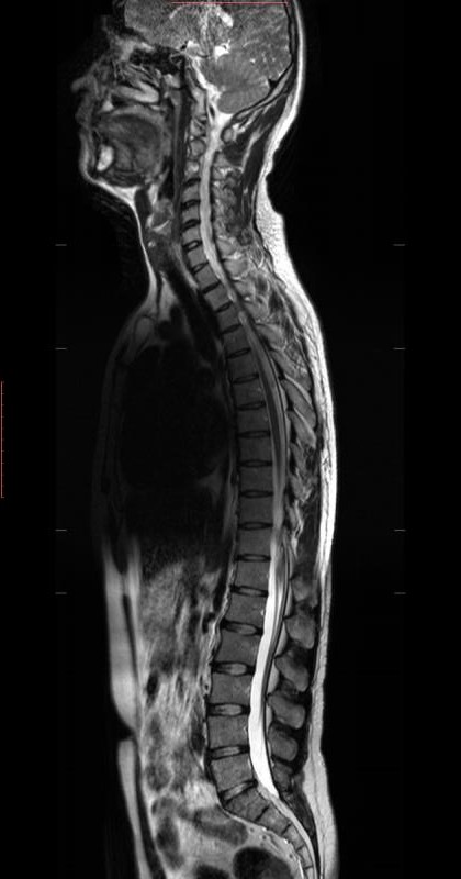 Whole spine-T2